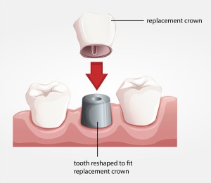 Dentistry for the Entire Family Dental Crown Illustration