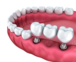 Dentistry for the Entire Family Dental Implants Supported Bridge