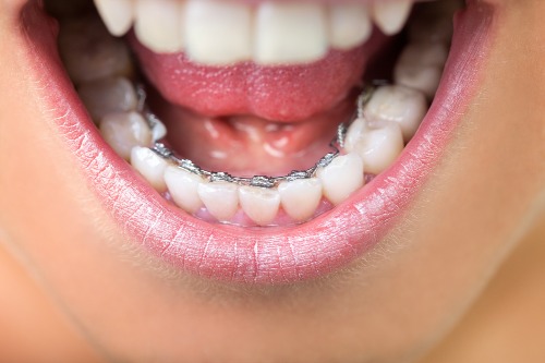 Incognito or lingual dental braces at Dentistry for the Entire Family