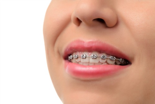 Traditional metal dental braces at Dentistry for the Entire Family