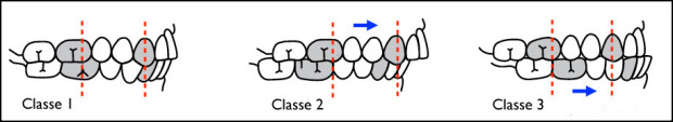 Dental braces occlusion classification illustration