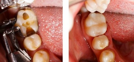 Composite dental filling procedure