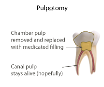 Illustration depicting an pulpotomy. Dr. Laing DDS specializes in root canal treatment for kids. Call 763-586-9988 to schedule an appointment.