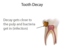 Illustration showing extensive decay in primary tooth. Dr. Thyra Jagger DDS specializes in root canal treatment for kids. Call 763-586-9988 to schedule an appointment