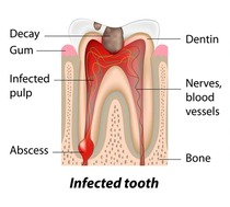 Illustration of an infected tooth that needs root canal. Call Dentistry for the Entire Family at 763-586-9988 to schedule an appointment.