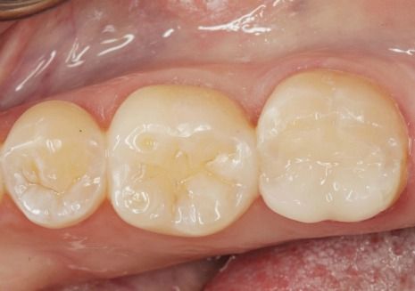 Porcelain dental fillings picture