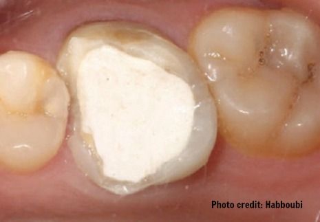 Temporary dental filling picture