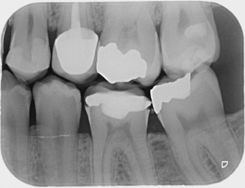 Digital dental bitewing x-rays