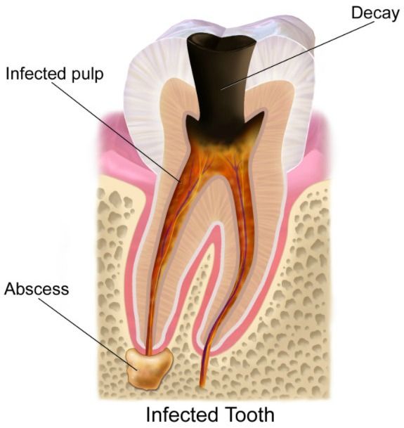 Tooth abscess and trauma can cause sensitive teeth