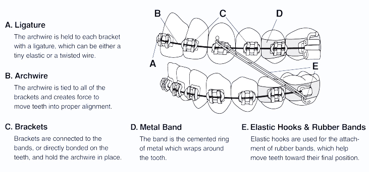 Dental braces terminology