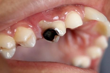 Tooth decay may appear as a black spot on a tooth