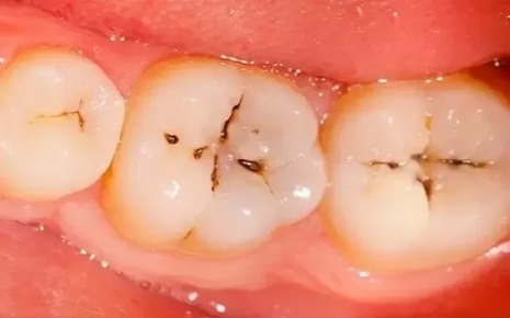 Tooth on watch for cavity