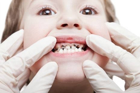 Picture of child with cavity