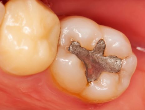Picture of cavity around dental filling