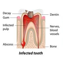 Diagram of tooth with a cavity