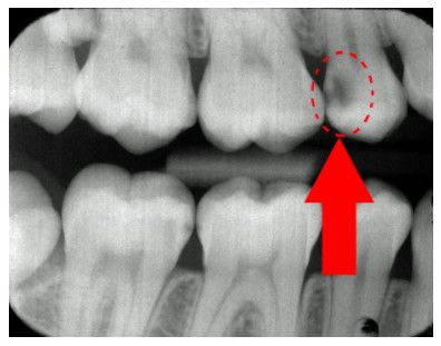 Picture of dental cavity between teeth