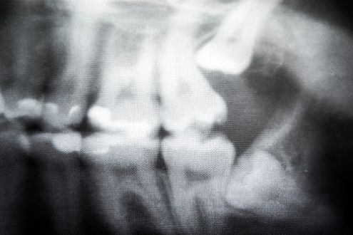dental x ray showing wisdom teeth at angle