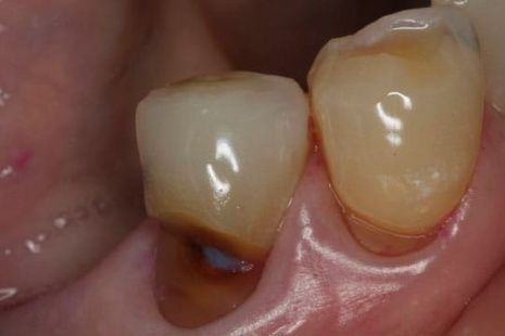 Picture of tooth cavity at gum line